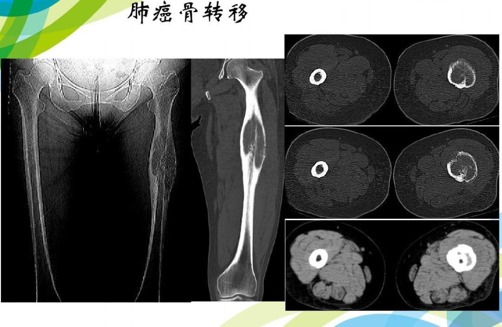 癌症患者需注意!肺癌骨转移药物可能出现少见不良反应