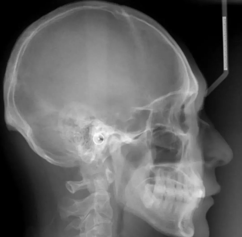 图3是人类头骨侧位图,可以看到这个人枕外隆突挺明显的,下面连着淡淡