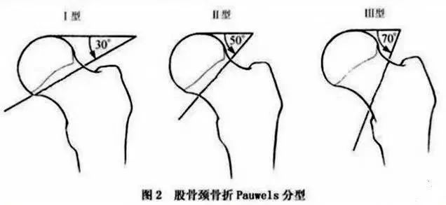 按骨折线的方向分型 外展型:pauwels角 30度,股骨头向外翻,外侧骨