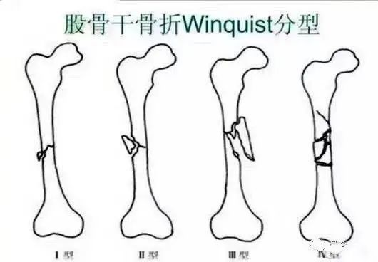 五,股骨远端骨折