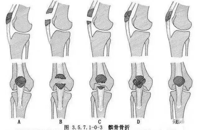 骨科精读|下肢骨折常用分型大全,果断收藏