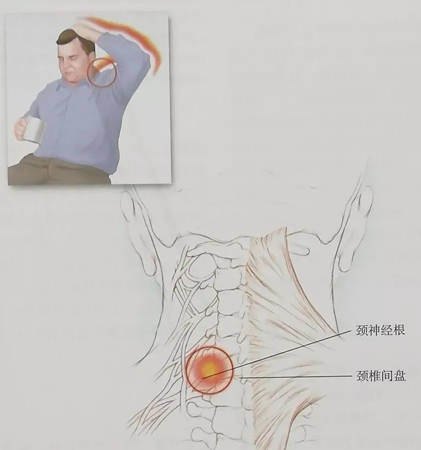 十种引起颈部和上肢神经的疼痛综合征