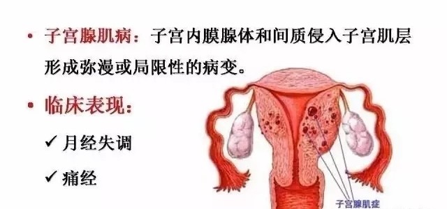 子宫腺肌症介入栓塞治疗