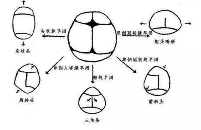 不同的颅缝早闭导致不同的颅腔畸形,如矢状缝早闭导致舟状颅畸形,也就