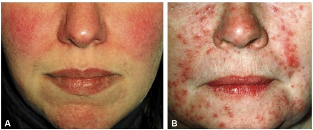 形似"痘痘"却不见粉刺;在发红的基础上可出现许多细小丘疹,脓疱;丘疹