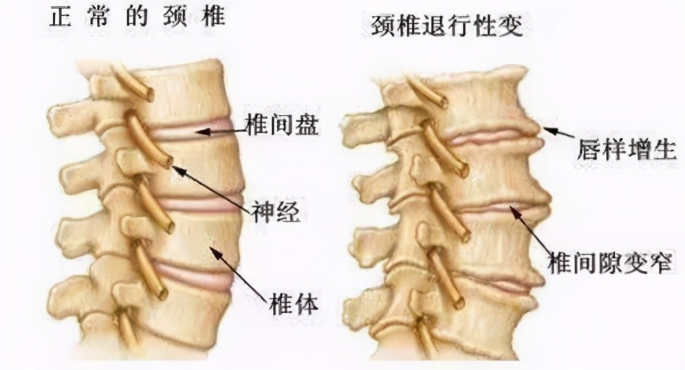 颈椎为什么会长骨刺,骨质增生?