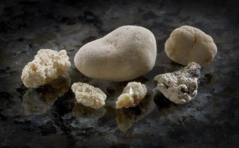 患上肾结石,一定要体外碎石?其实,还有这些办法