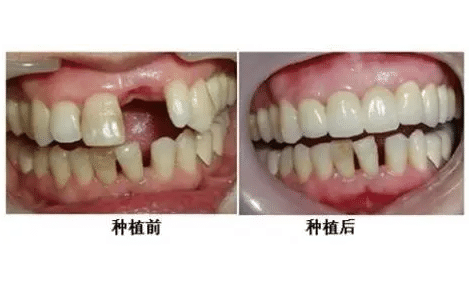 昌平门牙缺失可以去做种植牙吗