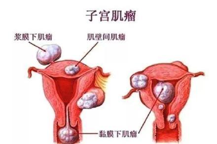 子宫肌瘤会不会癌变