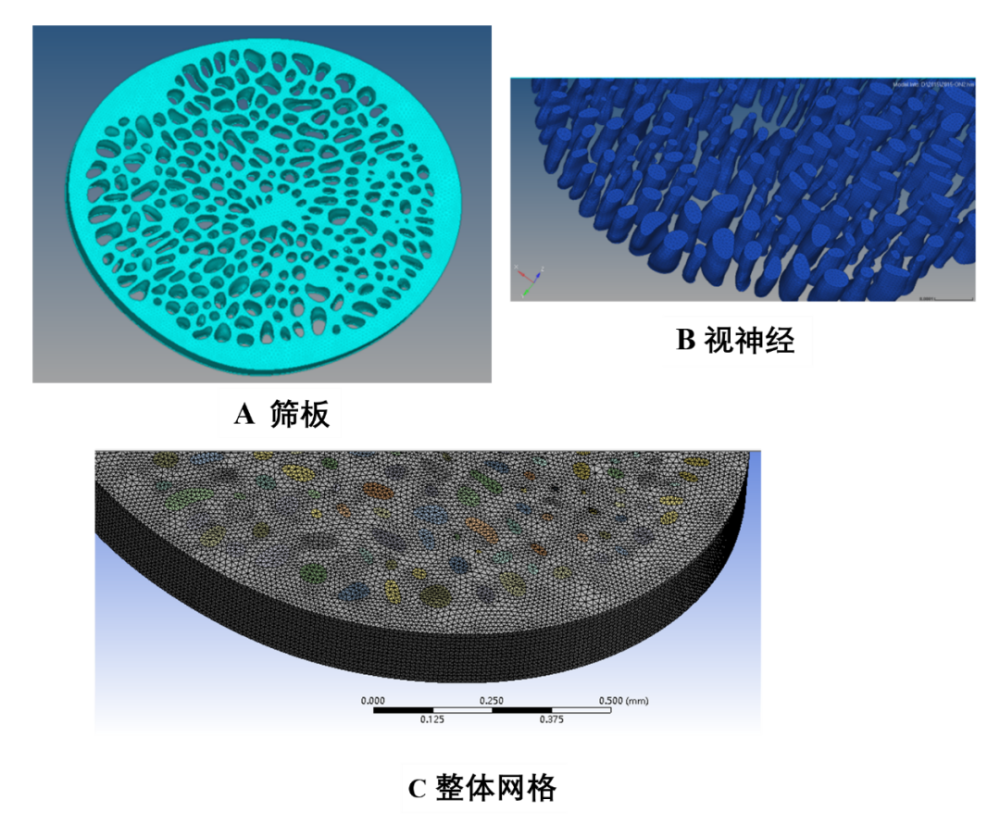 医学数值仿真应用分享:高眼压作用下筛板与视神经的变形分析