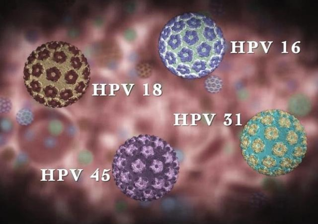 低危持续感染,可能会诱发湿疣和疣体,主要代表为hpv6和11;高危持续