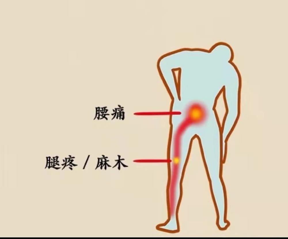 腰疼还是肾疼?医生 1 招教你分辨