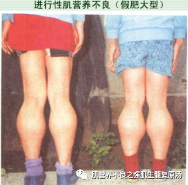 科普知识:杜氏肌营养不良(dmd型)!