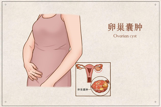 大多数卵巢囊肿都是功能性囊肿,一般不会出现临床症状,也没有身体不