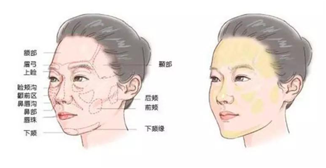 大部分面部凹陷下垂的原因都是衰老,胶原蛋白流失,支撑脸部的肌肉松弛