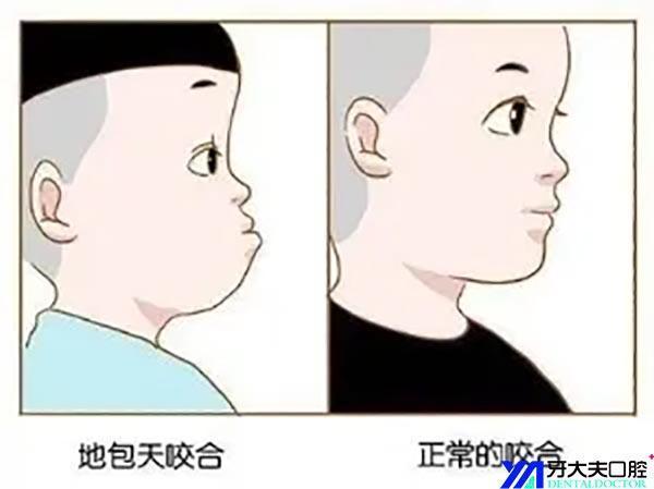 地包天 牙齿矫正,长沙牙大夫让你收获自信,爱上微笑
