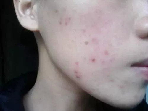 为什么一到夏天,就开始狂长痘痘?日常该如何预防长痘?