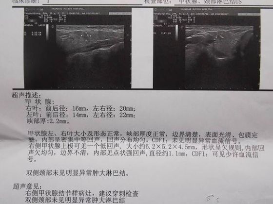 甲状腺超声检查这几个常见临床问题要知晓