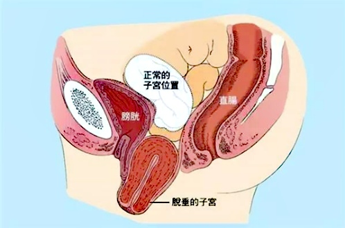 子宫脱垂分3度 Ⅰ度: 轻型:宫颈外口距处女膜缘 4cm,未达处女膜缘