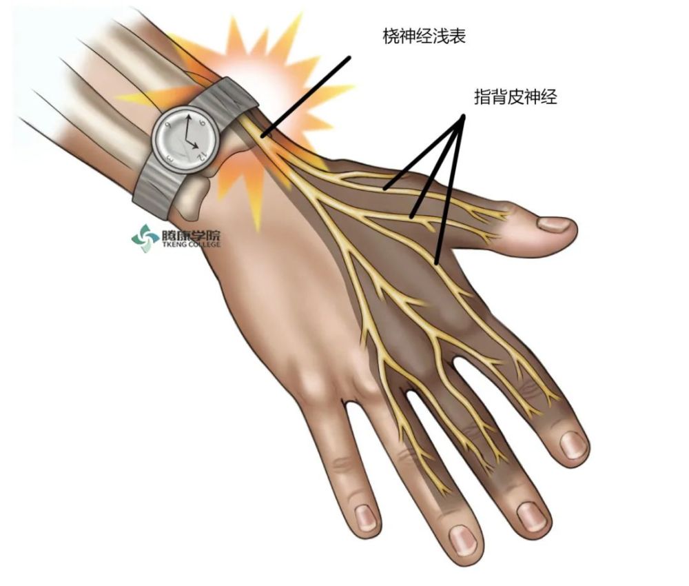 其症状多出现在桡神经感觉支受压时,如手腕佩戴过紧的手铐,手表带或