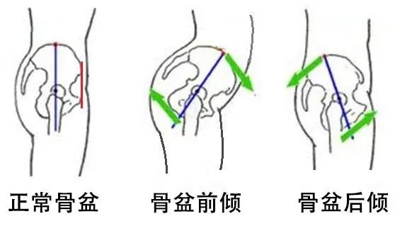 五个改善骨盆前倾的矫正拉伸训练|骨盆|肌肉|骨盆前倾