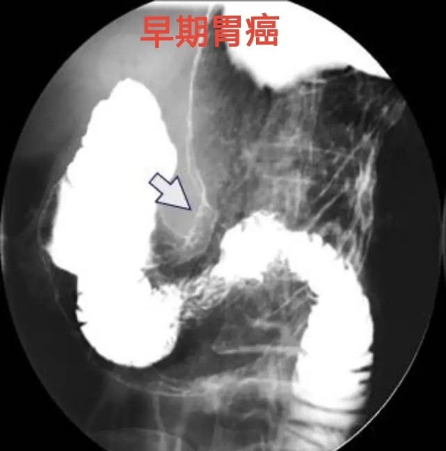 26岁男白领查出胃癌中晚期