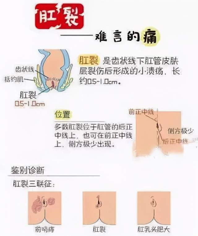 肛裂引起的大便出血怎么办?