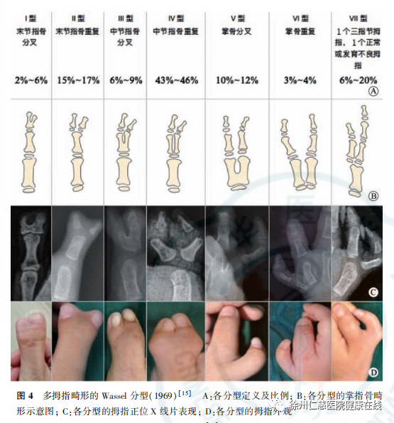 复拇指畸形保留哪一个舍弃哪一个