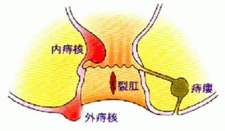 尴尬而常见的痔疮,跨不过的8个误区,真相是什么