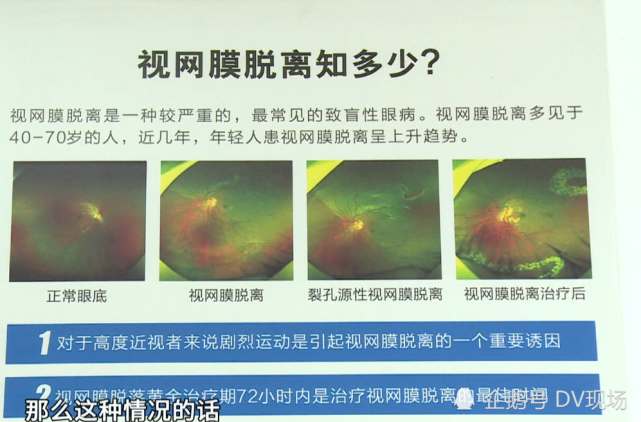 男子左眼被篮球击中,视网膜脱离险失明