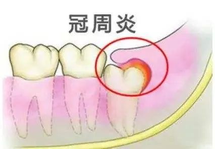 临床表现:第三磨牙的红肿,可有咀嚼和吞咽困难,张口受限,下颌淋巴结