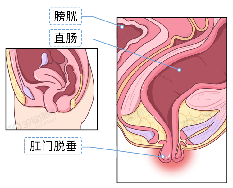 脱肛是一种怎样的体验4个因素是脱肛根源不要忽视了