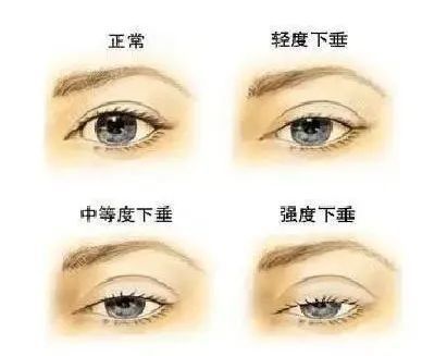 "左眼跳财,右眼跳灾"?眼皮跳到底是啥预兆!