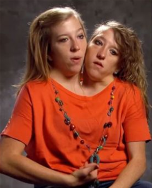 美国罕见双头姐妹花姊妹俩共享一个身体结婚成了大问题