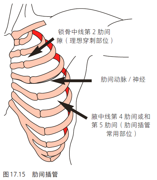 肋间插管(14号静脉插管针最好),或者用19号小针(必要时),沿着锁骨中线