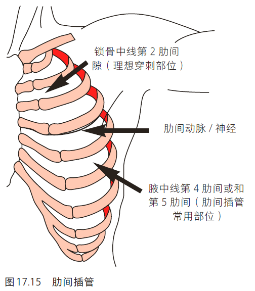 或者用19号小针(必要时),沿着锁骨中线第