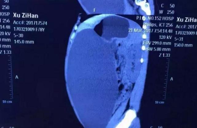 8岁女孩体内长15斤囊肿腹大如鼓 家长以为吃胖