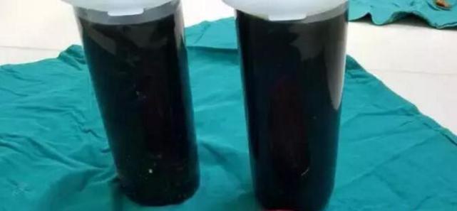 8岁女孩体内长15斤囊肿腹大如鼓 家长以为吃胖