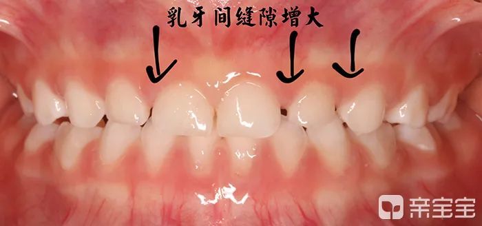 很多孩子长牙后,牙齿不像成人那样排列紧密,门牙可能会出现缝隙.