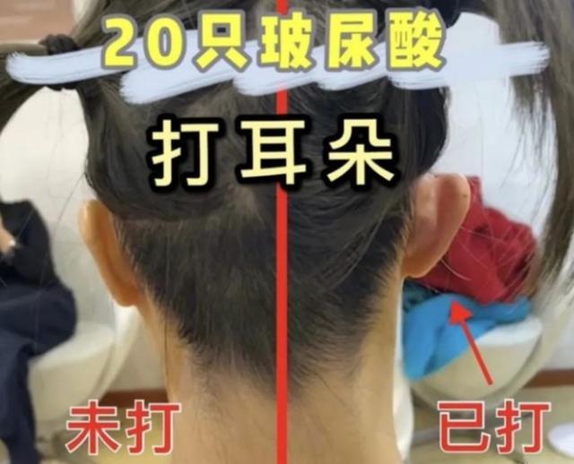 网红圈又一奇葩项目,继打针变成"精灵耳"后,又流行小腿阻断术