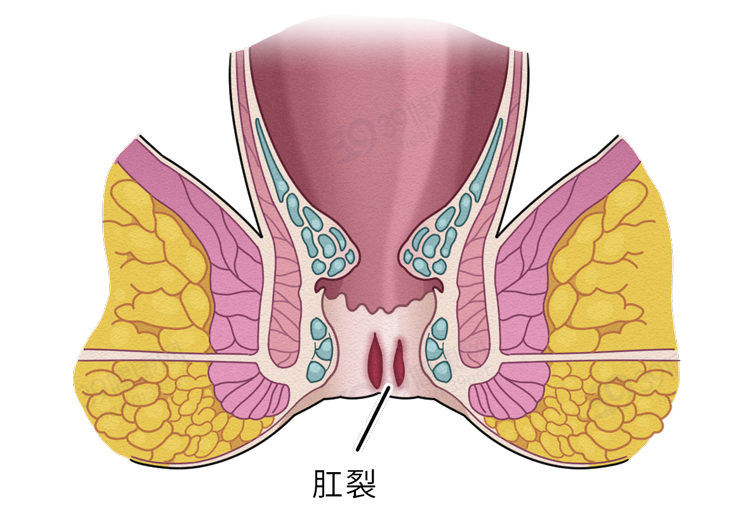 关于肛裂,你想了解的都在这里