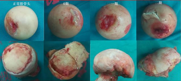 股骨头坏死到底长啥样?看图说话!