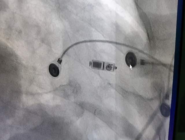 金州一院心内科成功植入首例micra无导线心脏起搏器