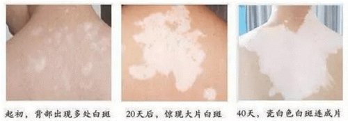 夏季白癜风高发,是什么原因?