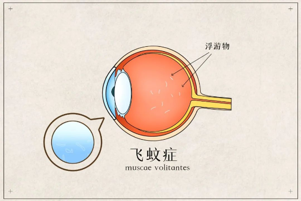 眼睛看东西有黑影飘动是怎么回事?别着急,上海眼底病专家告诉你