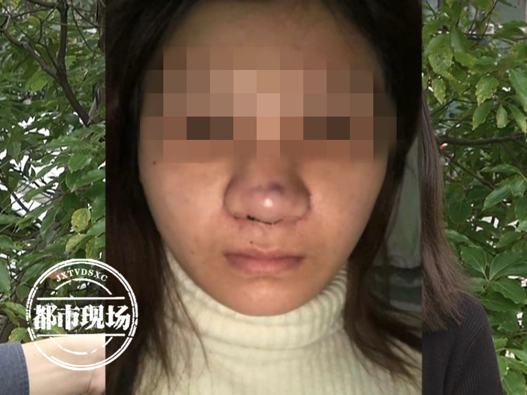 九江女子隆鼻后长出"疤痕",4个多月未消退,医生:还在恢复期