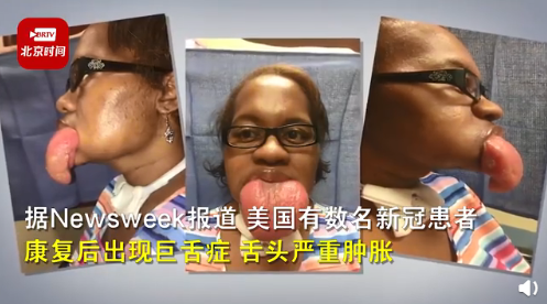 你们先看看图片,也太吓人了:第一个图片中的新冠康复者,名叫琼斯,舌头