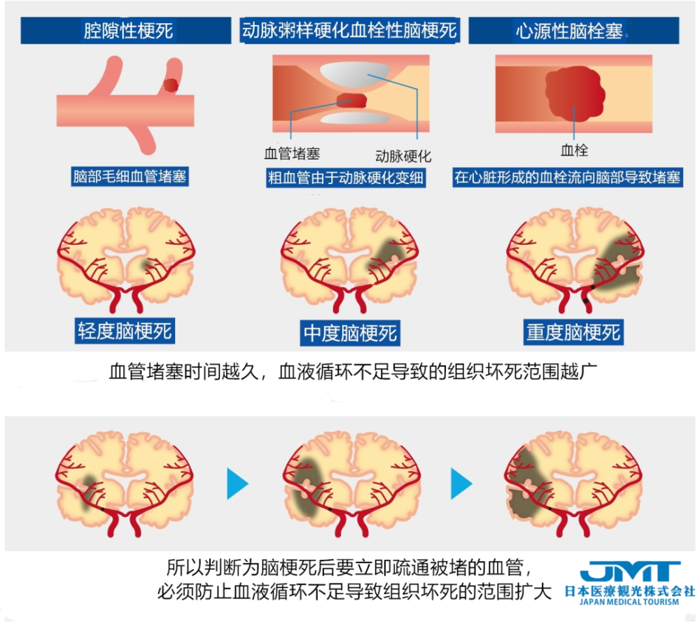 中国脑梗塞发病率世界第一,脑梗的血管内治疗方式详解