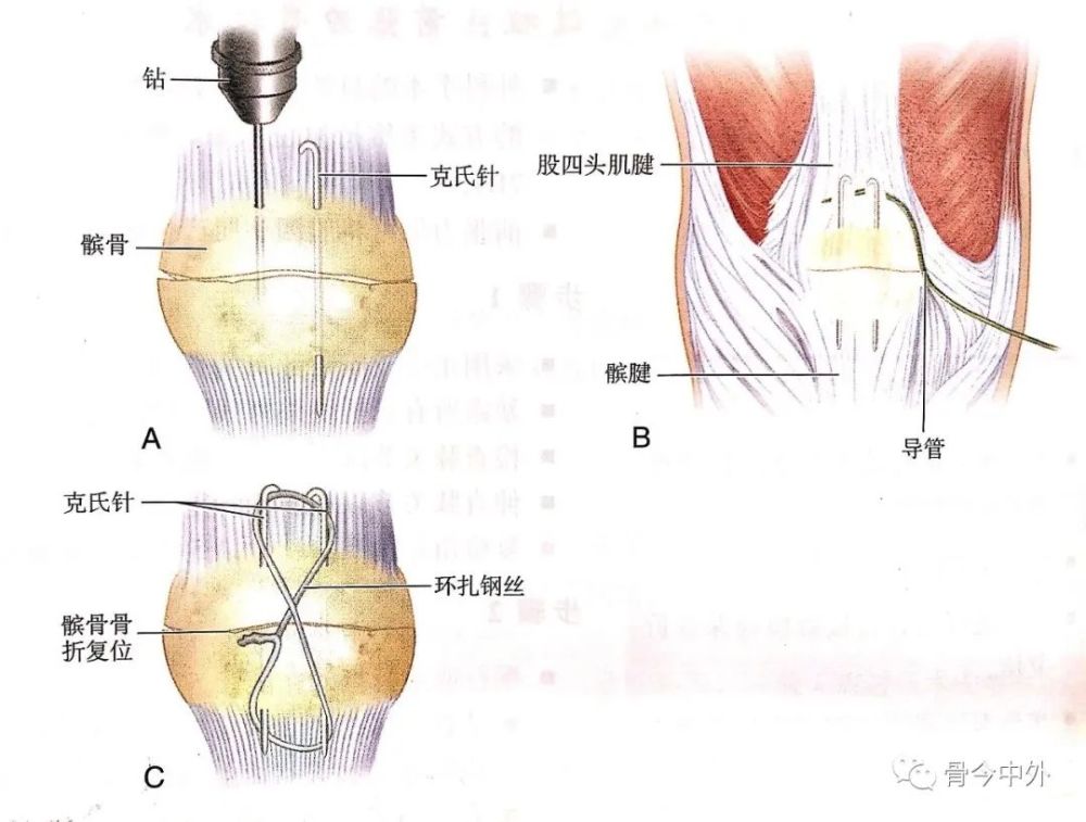 【骨科小技巧】髌骨骨折前张力带技术!