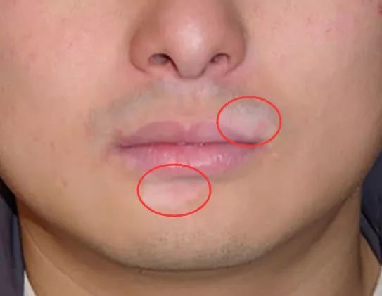 嘴巴白斑:如果我们的口腔中长出了白色的斑点,而且,这些白色的斑点